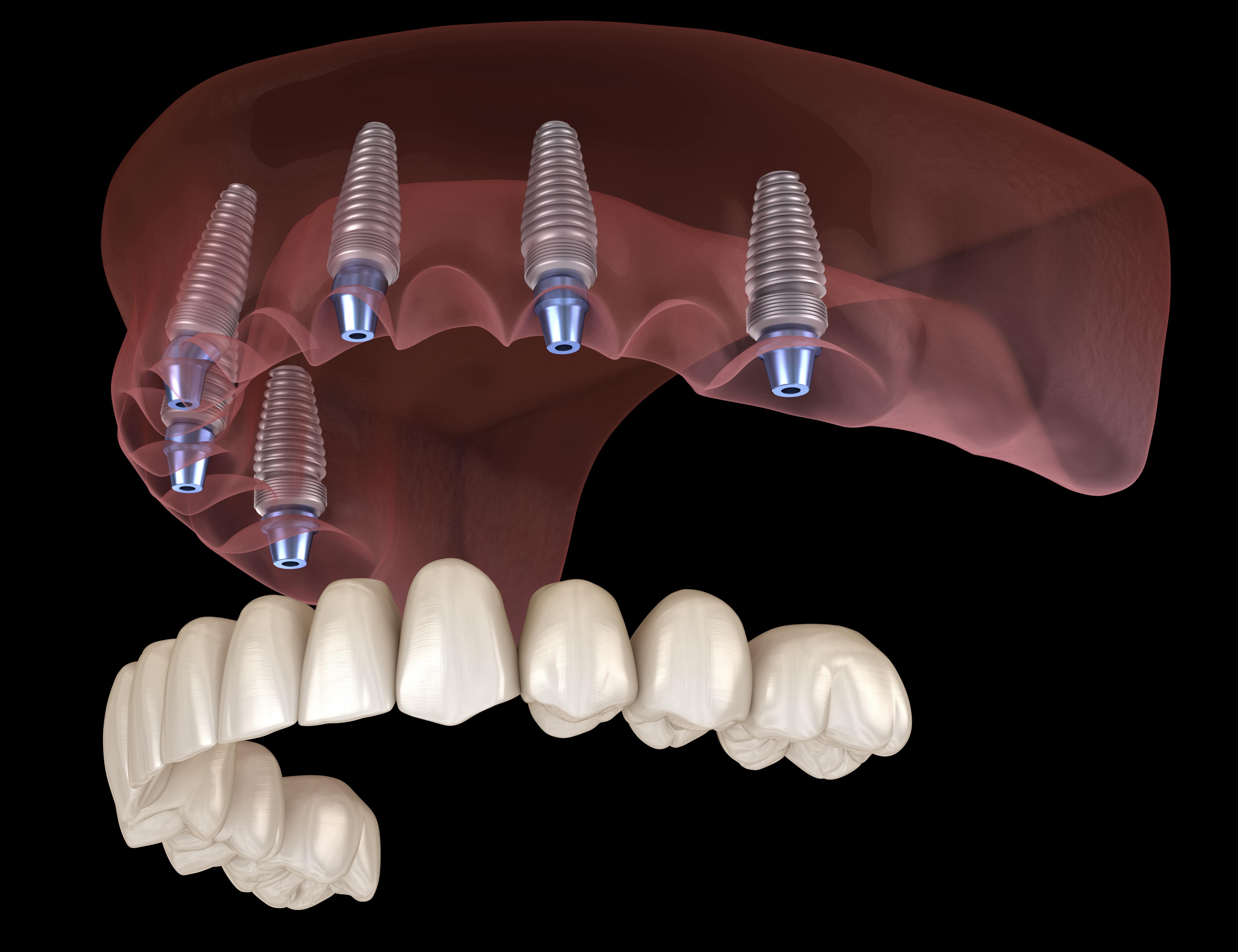 All-on-6 rögzítésű fogimplantátum.